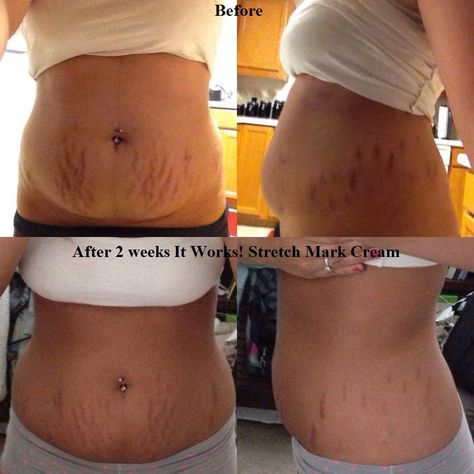 Pamper Your Skin - Shop Stretch Mark Creams Now! 🌟 stretch mark on neck, stretch mark on knee, stretch mark on hips #stretchmarks #selfcare #healthyskin Whiteheads Removal, Best Peel Off Mask, Stretch Mark Remedies, Marks Cream, Skincare Secrets, Acne Help, Stretch Mark Removal, Stretch Mark Cream, Stretch Mark