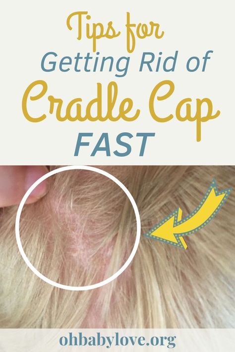 Stop doing the same thing over and over to get rid of your Baby or Toddler's Cradle Cap! It could just keep coming back unless you use one of these products that were suggested to us by our pediatrician! #baby #toddler #cradlecap #scalp #babyhacks #babystuff #babyessentials #topbbayproducts Toddler Cradle Cap, Cradle Cap Remedies, Baby Cradle Cap, Newborn Tips, Baby Taylor, Cradle Cap, Preparing For Baby, Parenting Toddlers, Baby Tips