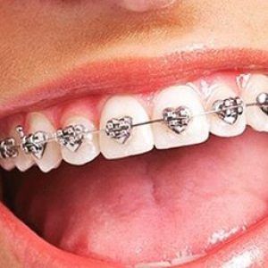 braces with love hearts for valentines dentist Aesthetic Braces, Dental Braces Colors, Teeth Images, Teeth Aesthetic, Cute Braces Colors, Braces Cost, Amazing Aesthetic, Braces Tips, Getting Braces