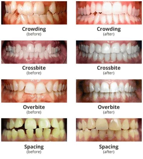 Braces With Crooked Teeth, Overbite Aesthetic, Braces With Gap Teeth, Braces On Crooked Teeth, Aligners For Teeth, Crossbite Teeth, Gap Teeth Aesthetic, Crooked Teeth Aesthetic, Crowding Teeth