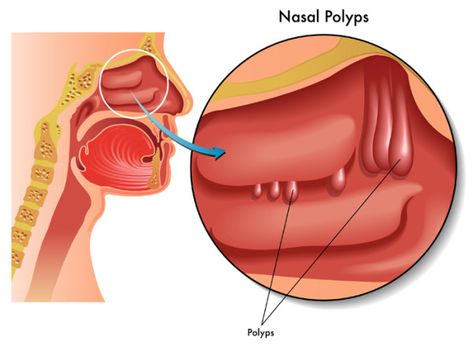 Sinus Polyps, Remedy For Sinus Congestion, Paranasal Sinuses, Home Remedies For Sinus, Chronic Sinusitis, Allergic Rhinitis, Sinus Congestion, Nasal Congestion, Vicks Vaporub