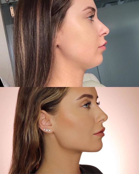 Skin by Lovely™ on Instagram: “repost from @kristinaxmakeup :  Side profile snatched 🔪🔪 so hard! 🤭🤫 I’ve always had a defined jawline until I gained a ton of weight and…” Non Surgical Jawline, Snatched Jawline, Snatched Face, Face Plastic Surgery, Defined Jawline, Chin Filler, Side Profiles, Rhinoplasty Nose Jobs, Face Fillers