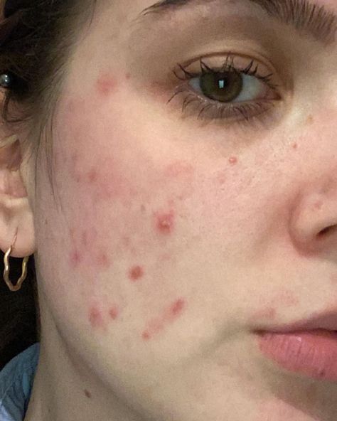 Diana’s Instagram profile post: “Anyone else having even more breakouts due to face masks? Need to try and find better materials😭 #acne #maskcne #maskne #spots #breakout…” Breakouts On Face, Growing Confidence, Acne Positivity, Skin Positivity, Regular Skin Care Routine, Marks Cream, Scar Removal Cream, Clean Blackheads, Prevent Pimples