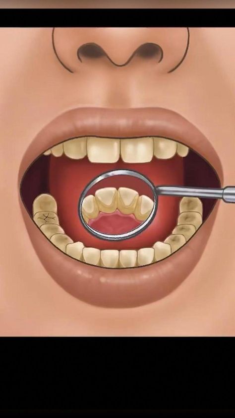 #Nutrition Dental Wallpaper, Tooth Decay Remedies, Dental Videos, Dental Fun, Dental Cavities, Emergency Dentist, Oral Care Routine, Family Dentistry, Oral Health Care