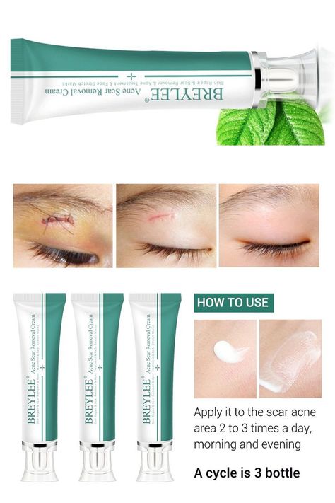 Pimple Remover Cream, Acne Scar Removal Cream, Scar Removal Cream, Pimple Scars, Scar Cream, Pimples On Face, Stretch Mark Cream, Friend Lyrics, Acne Scar