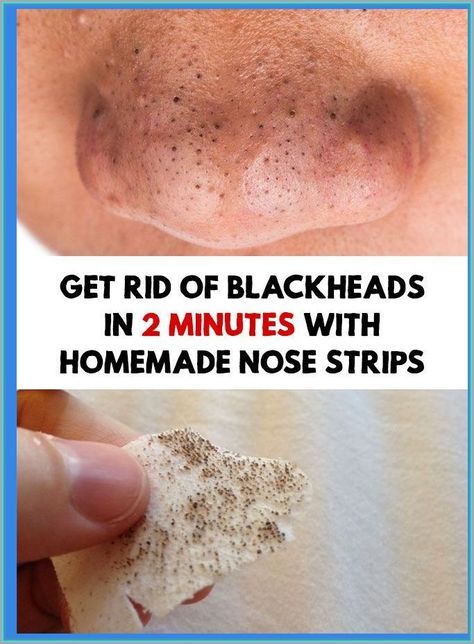 Get Rid of Blackheads For Good Homemade Nose Strips, Remove Blackheads From Nose, Maquillage Yeux Cut Crease, Blackheads On Nose, Rid Of Blackheads, Black Heads, Pore Strips, Easy Bun, Nose Strips