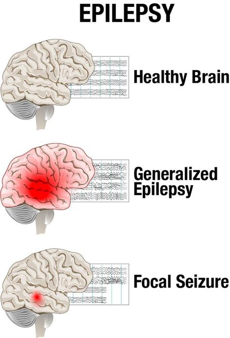 Epilepsy - A Neurological Disorder... What triggers an epileptic seizure? Wanna know more?? 👇👇 Stay tuned with us!! #medibiztv #dailyupdates #epilepsy #neurological #disorder #Seizures #effects #healthcare #awareness Types Of Seizures, Seizures Awareness, Nursing School Notes, Neurological Disorders, Medical Knowledge, Brain Activities, Koh Tao, Neurology, Lifestyle Changes