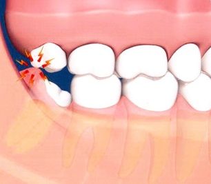 Exposure of Impacted Teeth | Teeth grow into the mouth by passing through the gums and emerging into their natural position. Sometimes, however, a tooth becomes “stuck” and either does not emerge or only partially emerges into the mouth. When this occurs, the tooth is said to be “impacted.” The most common impacted teeth are the wisdom teeth in the back of the mouth and the canines in the front of the mouth. Teeth Pain Relief, Wisdom Teeth Pain Relief, Wisdom Teeth Recovery, Wisdom Teeth Pain, Tooth Extraction Aftercare, Tooth Extraction Healing, Wisdom Tooth, Dental Implant Surgery, Teeth Whitening Homemade