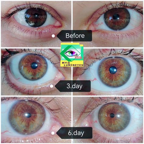 Grade 3-4 medium brown eyes, in 6 progression with Lumineyes xtra laser eye color change by Dr. Mustafa Mete. You can change your eye color naturally.. #lumineyes #lasereyecolorchange #lumineyesxtra #drmustafamete #eyecolorchangelaser #blueeyes #browneyes #browntoblue #eyecolorchangesurgery #eyecolors #eyecolorchange #changeyecolor #changingeyecolor More for change your eye color naturally : https://mylumineyes.com/how-to-change-eye-color-with-laser/ Manifest Eye Color, Eye Color Change Naturally, Subliminal Eye Color Change Results, How To Change Eye Color, How To Change Your Eye Color, Eye Color Subliminal Results, How To Change Eye Color Naturally, Changing Eye Color Naturally, Eye Subliminal