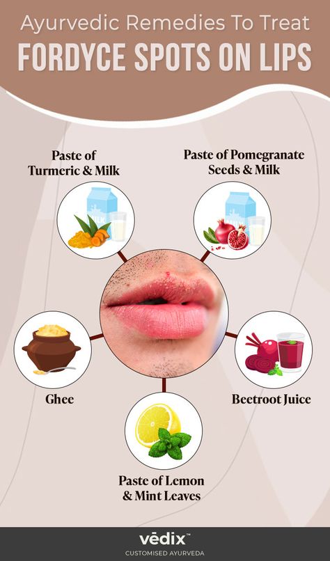 Fordyce Spots On Lips: How Does It Look? + Causes & Treatments – Vedix Fordyce Spots On Lips, Ayurvedic Tips, Turmeric Milk, Dark Spirit, Ayurvedic Remedies, Decorating Videos, Homemade Beauty, Cold Remedies, Oral Health Care