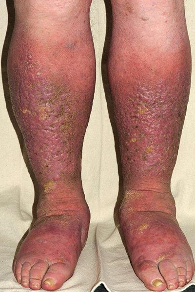 causes Swollen Legs Remedies, Leg Ulcers, Subcutaneous Tissue, Swollen Legs, Blood Sugar Diet, Poor Circulation, Daily Health Tips, Support Network, Chronic Condition