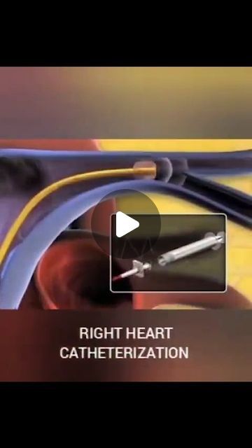 CardioVisual: Powered By MedicalVisual on Instagram: "Right heart catheterization animation  In this clip the Swan-Ganz catheter starts in the right atrium>right ventricle>pulmonary artery >pulmonary capillary wedge pressure  There are a multitude of things you can diagnostically do with a right heart cath. Things like basic pressures, valve studies, shunts, and cardiac output.  Which valve would we be assessing if we did a simultaneous pressure of the PCWP and LVEDP? 👇  .  .  .  .  .  Source @cardiovascularhc  #heart #cardiac #cardiacsurgery #cathlab #diagnostics #cardiologyfellow #medstudent #medicalstudent #cardiology #physician #doctor #physicianassistant #nurse #cardiacnurse #cardiologynurses #registerednurse #aprn #medical #procedure" Right Heart Catheterization Pressures, Right Heart Catheterization, Cardiac Output, Heart Catheterization, Cardiology Nursing, Interventional Cardiology, Cardiac Nursing, Physician Assistant, Med Student