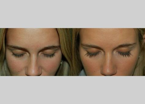 Latisse Before and After Photo Lash Growing Serum, Make Eyelashes Grow, Lashes And Eyebrows, How To Grow Eyelashes, Brow Serum, Thick Lashes, Extreme Hair, Eyelash Growth, After Photos