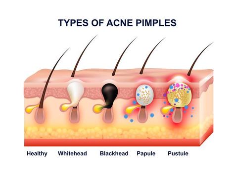 Different Types Of Acne, Skin Anatomy, How To Clear Pimples, Forehead Acne, Pimples Under The Skin, Skin Facts, Types Of Acne, How To Get Rid Of Acne, Skin Cleanser Products