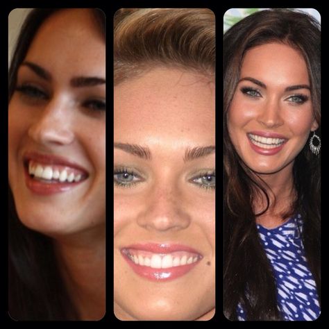 Megan Fox Before/After Veneers Megan Fox Before After, Celebrities With Veneers, Gummy Smile, Fox Eyes, Smile Teeth, Eye Surgery, Perfect Smile, Megan Fox, Without Makeup