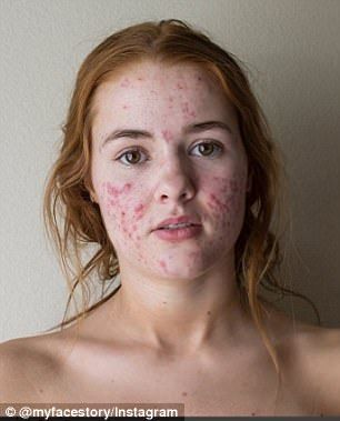 Acne Is Beautiful, Accutane Before And After, Best Acne Cream, Acne Pictures, Before And After Acne, Acne Journey, Im Beautiful, Acne Positivity, Skin Positivity