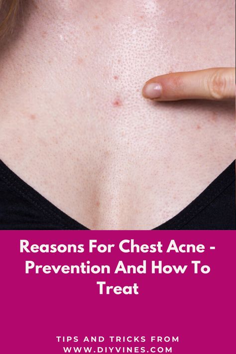 Reasons for chest acne are same as regular acne.  Chest acne is also called body acne. The main reason for Chest  acne is overproduction of sebum by the sebaceous glands. When there is an over production of sebum (skin oil) in body, skin pores become clogged.  #acne #chestacne #acnecauses #acneprevention #acnetreatment #beautytips #DIY #homeremedies Chest Acne Remedies, Acne Reasons, Pregnancy Acne, Chest Acne, Blind Pimple, Pimples Under The Skin, Prevent Pimples, Bad Acne, Natural Acne