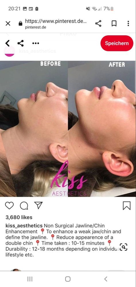 Chin Jaw Filler, Chin Enhancement Before After, Cheek And Chin Filler, Facial Plastic Surgery Before After, Jaw And Chin Filler Before And After, Before And After Jaw Filler, Face Plastic Surgery Before After, Jaw Contouring Filler, Face Surgery Before And After