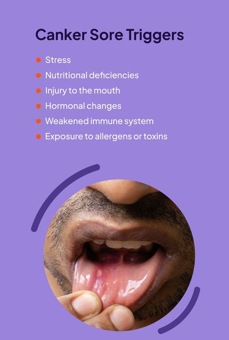 What Causes Canker Sores? Canker Sore Causes, Mouth Blisters, Canker Sore Remedy, Flossing Teeth, Mouth Care, Dental Images, Gastrointestinal Disease, Canker Sore, How To Prevent Cavities