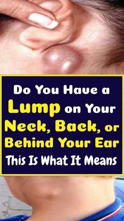 Lump Behind Ear, Muscle Knots, Skin Bumps, Health Signs, Women Health Care, Sleep Health, Health Care Services, Itchy Skin, Health Articles