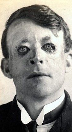 The world's first recorded skin-graft related plastic surgery, WWI survivor William Yeo (after recovery). His eyes, man. His eyes. Wwi Soldier, Human Oddities, Skin Grafting, Reconstructive Surgery, Vintage Medical, Amazing Pictures, Face Expressions, Two Faces, Human Face