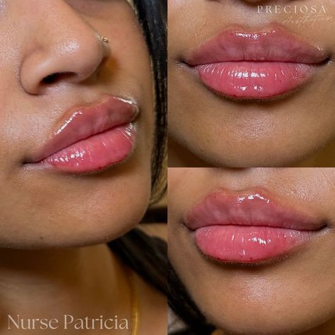 Lips by Preciosa 🤍🩷 #lips #lipfiller #dermalfillers #chinfiller #mississaugalips #oakvillelips #torontolips #portcreditlips #botox #dysport #nucieva #nurse #nurseinjector #beauty #aesthetic #cosmetics #stylage #stylagelips #toronto #mississauga #portcredit #oakville Lip Injections Before And After Black Women, Botox Nurse Aesthetic, Overfilled Lips, Lip Filler Black Women, Light Lip Filler, Top Lip Filler, Lip Filler Styles, 0.5 Ml Lip Filler Before And After, Natural Lip Fillers