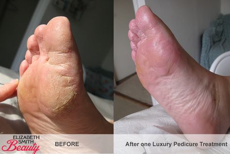 Pedicure Before And After, Skin Tags Apple Cider Vinegar, Skin Cream Recipes, Diy Foot Soak, Skin Hand, Foot Soak, Cracked Skin, Coconut Oil For Skin, Layers Of Skin