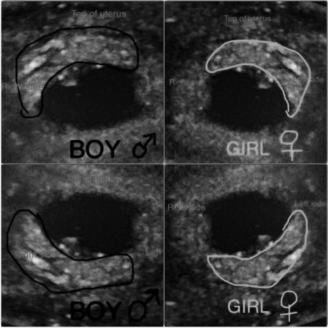 Unsure how accurate this is but it's fun to guess right? Are you having a boy or a girl? Find out based on your ultrasound! Boy Or Girl Prediction Signs, Ultrasound Boy Or Girl, Boy Ultrasound Pictures, Baby Gender Ultrasound, Boy Or Girl Prediction, Pregnancy Gender Prediction, Boy Or Girl Sign, Easter Baby Photos, Baby Gender Prediction