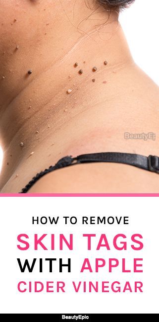 How to Use Apple Cider Vinegar for Skin Tags Remove Skin Tags, Apple Cider Vinegar For Skin, Remove Skin Tags Naturally, Skin Tags, Home Remedy For Cough, Cold Sores Remedies, Natural Sleep Remedies, Natural Cold Remedies, Cold Home Remedies