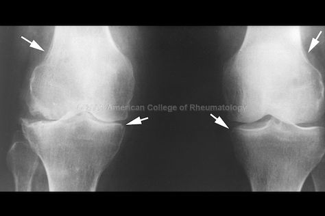 RA Anteroposterior projection shows a normal joint space in the knee on the right and gross narrowing on the left. The upper arrows indicate subperiosteal new bone formation. The lower arrows point to small marginal joint erosions. Larger erosions of the lateral compartment on the left are present. Note the symmetric narrowing of both compartments of the knee on the left. Magic Tattoo Ideas, Knee Replacement Surgery, Musculoskeletal System, Magic Tattoo, Orthopedic Surgery, Knee Pain Relief, Knee Surgery, Operating Room, X Rays