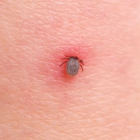 Seed Ticks How To Get Rid Of, Essential Oils For Tick Bites, How To Remove Ticks From People, Removing A Tick From A Person, Tick Removal Human, Tick Bite Rash, Tick Bites On Humans, Bug Bite Remedies, Tick Bites Pictures