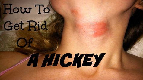 A hickey, also known as a kiss mark or love bite, is actually a kind of bruise. Hickies result ... to get rid of hickies. Here are the ways to remove hickies fast. Visit : http://papre.com/how-to-get-rid-of-a-hickey-useful-tips-for-you/ How To Give Love Bites Hickey, Love Bites Hickey, Get Rid Of Hickies, Love Bite, Kiss Mark, Menstrual Health, Give Love, Love Bites, How To Give