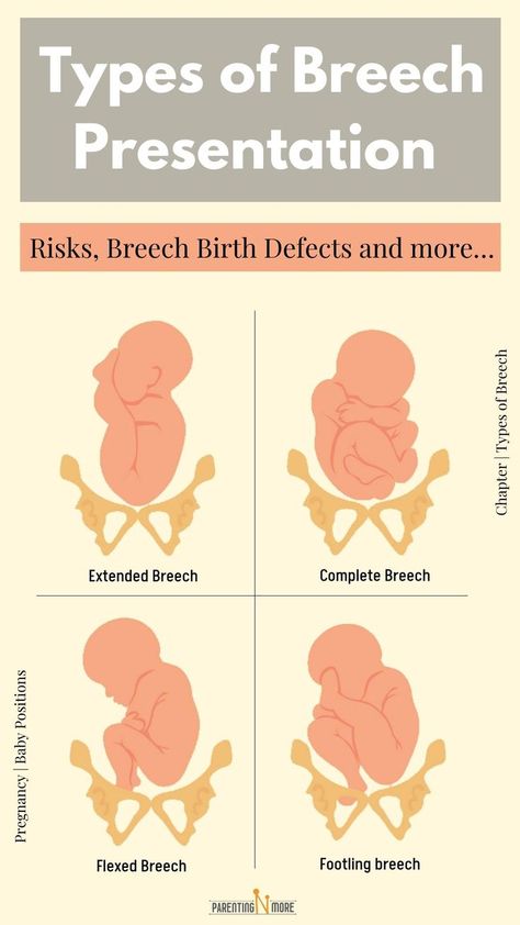 Know types of breech presentation along with detailed explanation on Breech definition. Article also throws light on risks involved and possible birth defects Ecv Procedure, Turn A Breech Baby, Breech Birth, Breech Babies, Birth Delivery, Doula Care, Nclex Study Guide, Birth Education, Mother Baby Nurse