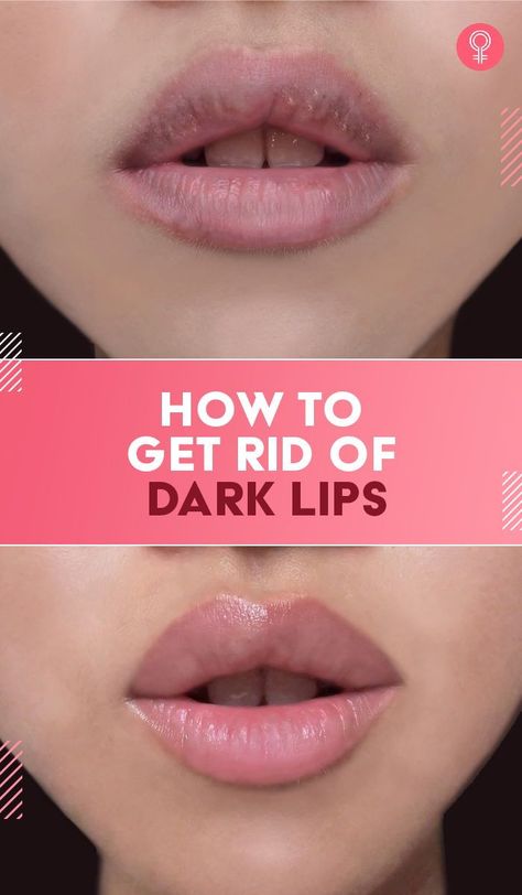 How To Get Rid Of Dark Lips: It is a known fact that everyone is born with a different shade and color of lips, but issues arise when hyperpigmentation occurs. Thus, it is important to recognize the cause and then go for treatments that work well to get rid of dark lips. Hyperpigmentation Remedies, Lighten Dark Lips, Softer Lips, Coconut Oil Coffee, Natural Face Skin Care, Dark Underarms, Dry Skin Remedies, Purple Lips, Free Advice