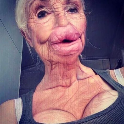 How girls these days will look in their 60's and 70's Botched Plastic Surgery, Surgery Humor, Botox Lips, Plastic Surgery Gone Wrong, Medium Shag Haircuts, Celebrity Plastic Surgery, Under The Knife, Celebrities Before And After, Reconstructive Surgery