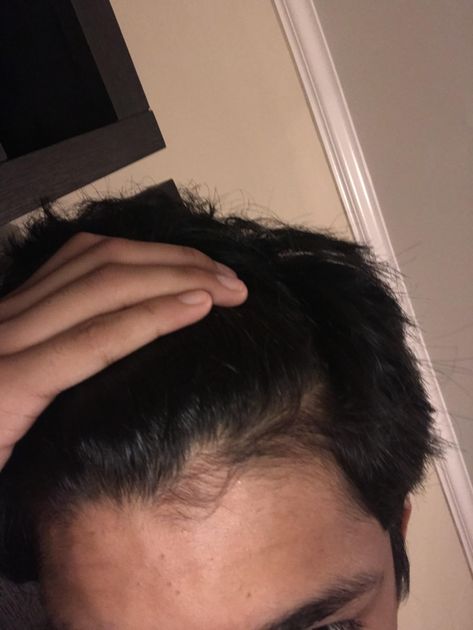 What is going on with my hairline and how do I fix it Fix It, Hair, Beauty, Quick Saves