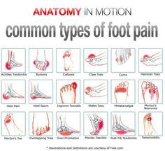 Foot Pain Chart, K Tape, Foot Exercises, Back Pain Remedies, Ankle Pain, Foot Pain Relief, Preventative Health, Hip Pain, Nerve Pain