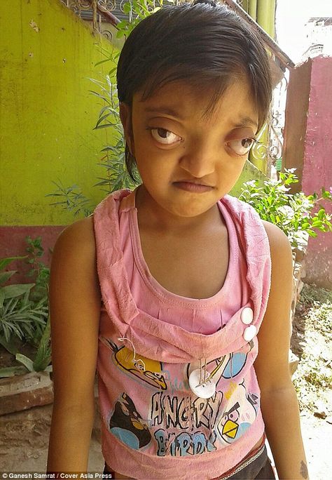 Shaili Kumari suffers from a genetic disorder called Crouzon syndrome - causing her head to be misshapen and giving her the appearance of bulging eyes Cat Eye Syndrome, Eyes Looking Down, Indian Eyes, Bulging Eyes, Human Oddities, Different Colored Eyes, Social Media Impact, Post Human, Genetic Disorders