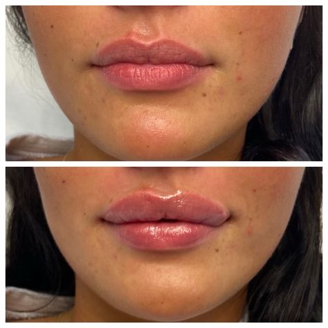 💋 Heart-Shaped Perfection Alert! 💖 Check out these stunning lip results from Front Door Medspa. Our patient desired a more pronounced upper lip, and Lauren R.N., our skilled injector, delivered just that with Juvederm Ultra. The result? Absolute heart-shaped perfection for this gorgeous girl! Dreaming of your perfect pout? Let us craft it for you. 💉✨$499 full syringe $350 half Book now  248-BEST SPA (237-8772) Lip Heart Shape, Heart Shape Lips Fillers, Bigger Upper Lip, Heavy Upper Lip, Desired Lips, Skin Anatomy, Heart Shaped Lips, Lip Filler, Lip Enhancement