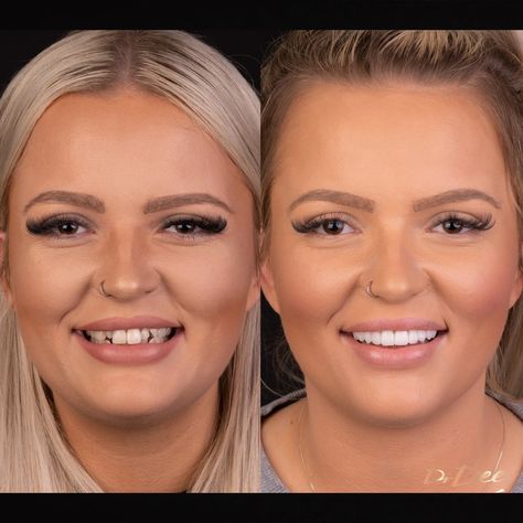 Our results gallery shows before and after images for treatments such as porcelain veneers, Invisalign Lite, Invisalign Full, teeth whitening, and gum laser surgery, Teeth Makeover, Permanent Dentures, Tooth Crown, Celebrity Smiles, Veneers Teeth, Beautiful Teeth, Laser Surgery, Porcelain Veneers, Dental Veneers