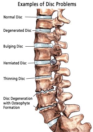 Some samples of the different kinds of disk problems you can have with your spine. Massage Logo, Bolesti Chrbta, Bulging Disc, Spine Health, Spine Surgery, Human Skeleton, Medical Anatomy, Medical Knowledge, Low Back Pain