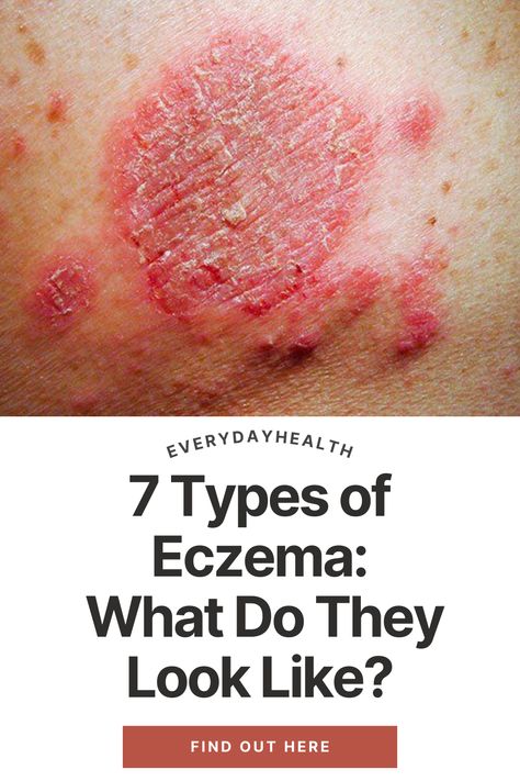 Treatments For Excema Natural Remedies, Severe Excema Remedies, Remedies For Excema, Dermitis Herpetiformis, Excema On Face Skincare, Exema Treatments Diy, Excema Remedies Diy, Atopic Dermitis Remedy, Seborrheic Dermitis On Face