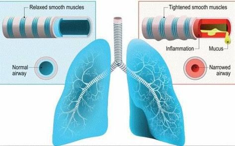 Lower Respiratory Tract, Acute Respiratory Distress, Muscle Inflammation, Respiratory Distress, Severe Cough, Chest Discomfort, Cleansing Spray, Respiratory Infection, Respiratory Diseases