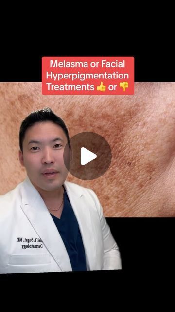 Dr. Daniel Sugai, MD, FAAD on Instagram: "Hyperpigmentation, specifically melisma is a hot topic in my practice!  Here’s a few explanations:  Niacinamide serums can cause irritant contact dermatitis rashes and may worsen #darkspotsonface and be careful when getting lasers as some lasers may worsen #melasma quite dramatically.   I see contact dermatitis in those using hydroquinone purchased OTC overseas too. Always consult your doctor on how to use hydroquinone appropriately since it is a prescription medication that can paradoxically worsen hyperpigmentation if used incorrectly! 😱😩  #melasma #hyperpigmentation #hyperpigmentationtreatment #melasmatreatement nt" What Is Hyperpigmentation, How To Fix Hyperpigmentation, Hyperpigmentation On Neck, Hydroquinone 4% Before And After, Removing Hyperpigmentation, Skin Care Hyperpigmentation, Skin Hyperpigmentation, Face Glow, Dark Spots On Face