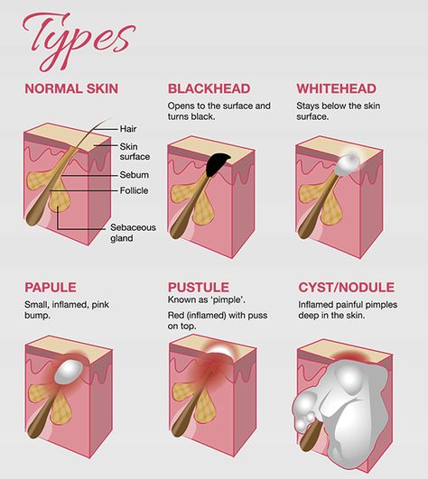 Types of Acne Acne Types, Hair Knowledge, Painful Pimple, Skin Anatomy, Medical Esthetician, Skin Facts, Skin Advice, Skin Aesthetics, Types Of Acne