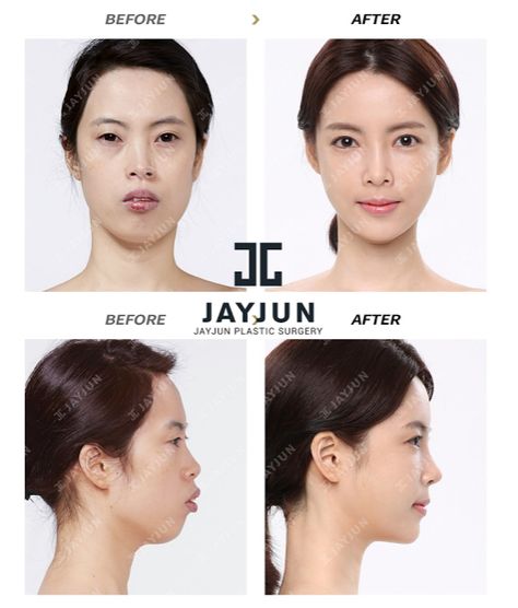 korean face contouring makeup korea facial contouring korea facial contouring surgery before and after korea facial bone contouring surgery korea facial bone contouring korea facial bone surgery korea facial feminization surgery cost korea facial contouring tutorial facial contouring plastic surgery in korea korea contouring the face korea contouring how to korea face reconstruction surgery Facial bone surgery in south korea Korea facial contouring surgery Facial contouring surgery Plastic Surgery Korea Before After, Face Contouring Surgery, Facial Contouring Surgery, Facial Reconstruction Surgery, Korean Surgery, Face Contouring Tutorial, Beauty Surgery, Contouring Tutorial, Knee Care