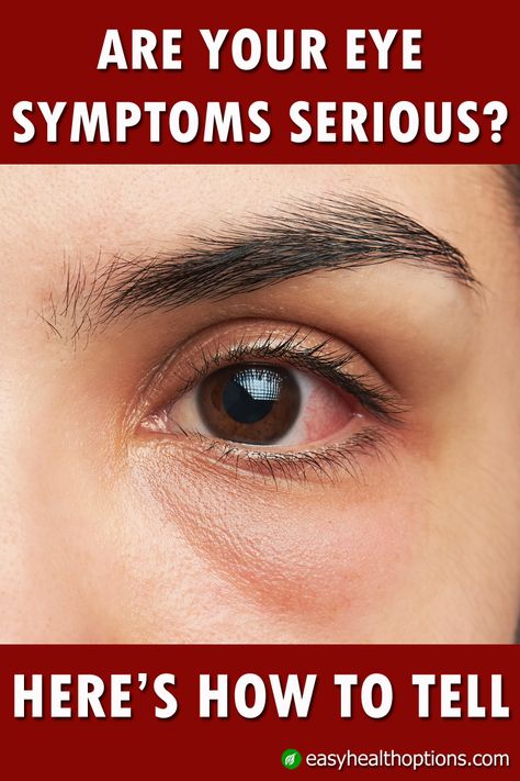 We all have times when our eyes are red, itchy or irritated. But how can you tell whether a color, swelling or other sensation is commonplace and nothing to worry about, or something you should get attention for immediately? Red Eyes Remedy, Itchy Eyes Remedy, Eye Irritation Remedies, What Causes Red Eyes, Dry Eye Remedies, Redness Remedy, Itchy Eyelids, Swollen Eyes, Irritated Eye