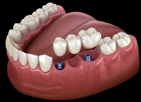 Cantilever Bridge, Bridge Support, Dental Posts, Dental Aesthetics, Illustration Human, Human Teeth, Dental Bridge, Dentures, Dental Implants