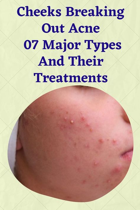 Cheeks Breaking Out Acne 07 Major Types And Their Treatments Do It Yourself, Makeup Brushes, Cheek Acne, Everyday Habits, Skin Disorders, Diy Health, Makeup Makeup, Skin Problems, The Face