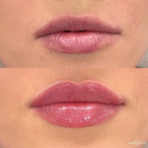 1ml Lip Filler, Restylane Lips, Face Injections, Derma Fillers, Lip Surgery, Lip Permanent Makeup, Lips Inspiration, Permanente Make-up, Botox Lips